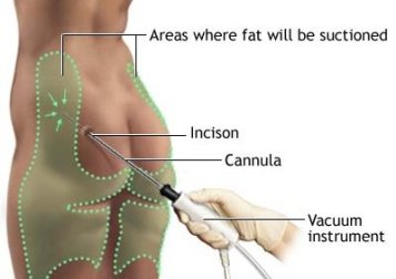 fat lost through liposuction is back within a year thighs abdomen 